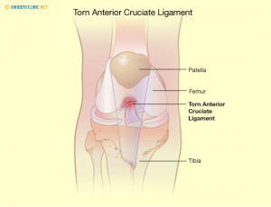 Damaged ACL.